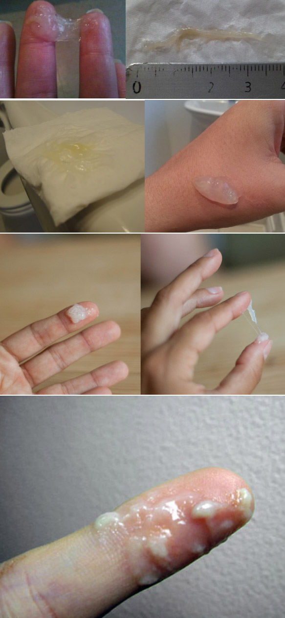 Muco sticky (pegajoso) — consistência de cola, quebra facilmente, fase pouco fértil